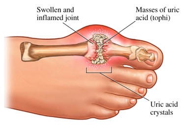 "Naturopathic Therapies and Diet for Uric Acid: A Holistic Approach to Gout Management"